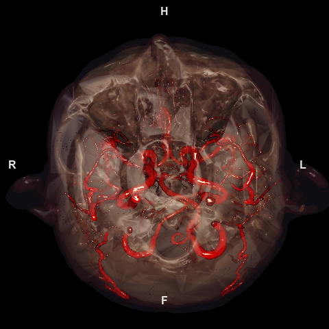 3D vessel rendering (VR) — cerebral vessels through a translucent skull