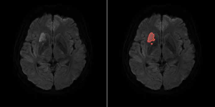 DWI with AI infarct overlay — representative case