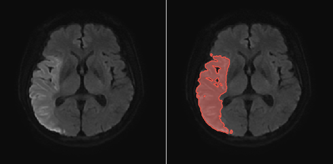 DWI with AI infarct overlay — representative case