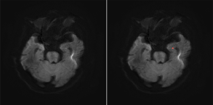 DWI with AI infarct overlay — representative case