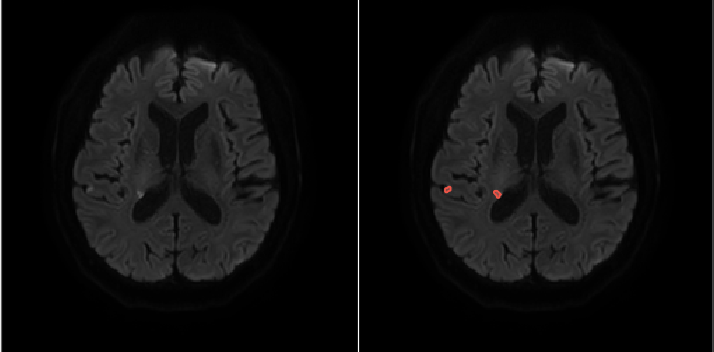 DWI with AI infarct overlay — representative case